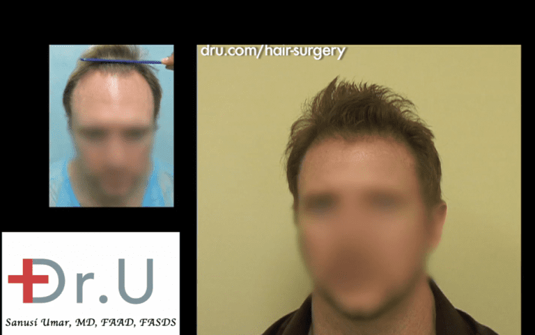 Receding Hairline Stage Transformed For Renewed Hairline Receding Hairline Stage Transformed For Renewed Hairline
