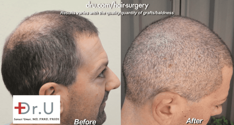 This patient was not only able to repair strip surgery mistakes but also to wear a buzz cut after a hair transplant * Beard and head hair grafts were used to conceal strip scars. Here are before and after photos