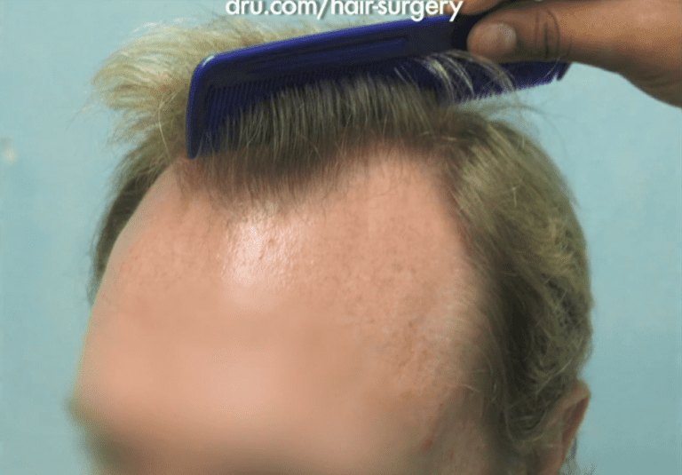 Treatment for Advanced Hairline Recession Treatment for Advanced Hairline Recession