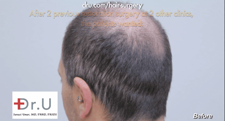 Sydney, Australia patient hopes to conceal strip scars through his body hair transplant with Dr. Umar Sydney, Australia patient hopes to conceal strip scars through his body hair transplant with Dr. Umar