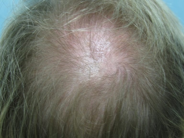 Newport Beach patient before his hair transplant for thinning crown Newport Beach patient before his hair transplant for thinning crown