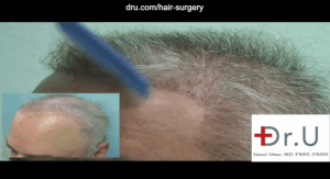 This patient required a body hair transplant for repairing a donor depleted scalp. This before and after image highlights the left temple oblique view, showing improved overall coverage and natural looking hairline and temples constructed with body donor hair. 