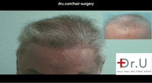 Dr. Umar used abdomen, beard and chest hair to repair a flap surgery hairline scar and achieve a natural-looking coverage for the top of this patient's head. 