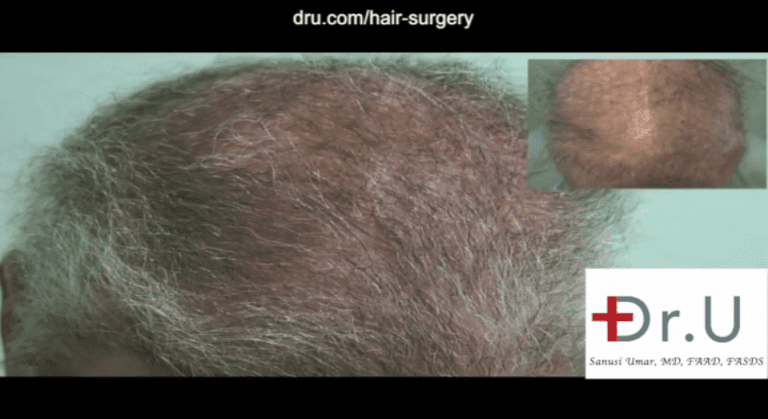 A body hair transplant for impossible repair is able to expand the donor supply, which is critical in cases like this when the head can no longer provide enough grafts. Body hair was used to achieve a normal looking coverage to adequately conceal the scars from past surgeries. 