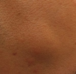 Benign cysts are harmless. But their appearance can still be distressing for patients, which is why many opt to have them removed. Los Angeles dermatologist Dr. Umar has years of experience in cyst removal for a normal cosmetic appearance. 