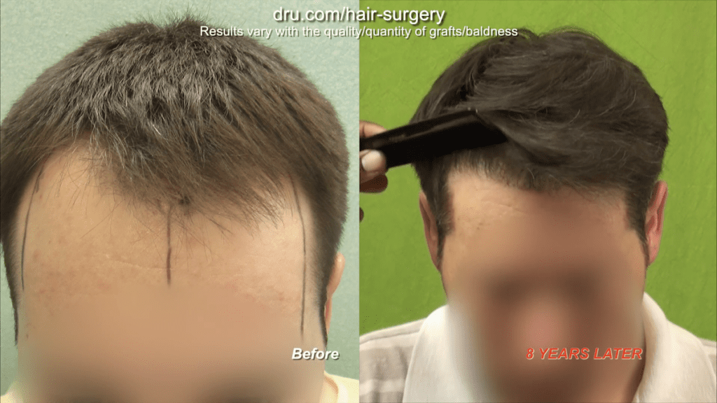 Dr. Umar runs a comb through the patient's hair 8 years after the patient's hairline restoration to show how the nape hair grafts survived long-term, while the patient continued to lose hair behind the transplanted area, showing that nape hair can be a permanent donor area. Nape hair allowed Dr. Umar extract how many grafts needed for hair transplant - 3,200 in total.