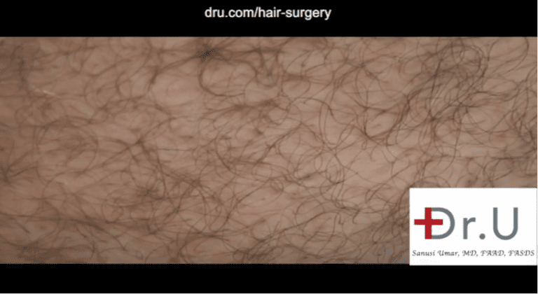 This patient's hair restoration with 10,000 grafts included graft taken from the abdomen. In this photo, a close-up view is shown six months after his surgery. This donor area shows no obvious signs of surgical extractions