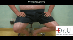 Manhattan Beach, Los Angeles patient was able to undergo a body hair transplant for impossible repair where hair was removed from his abdomen, chest, arms, thighs and beard. Here is a photo showing his donor areas in the lower areas of the body.
