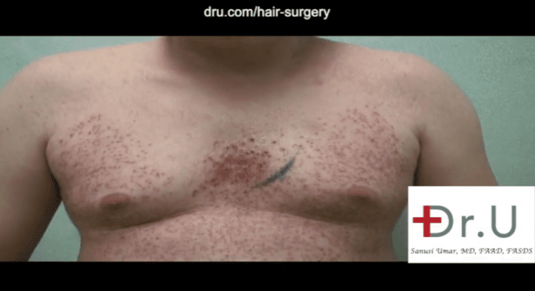 Patient on the last day of his body hair transplant surgery showing his chest after donor grafts were harvested