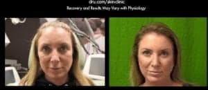 Botox and Dysport can be used for facial wrinkles and eyebrow lifts by relaxing specific muscles