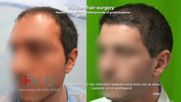 For Los Angeles patients who wonder, "does platelet rich plasma work for growing hair after a hair transplant," the answer is no. Results will depend on the surgeon's skill