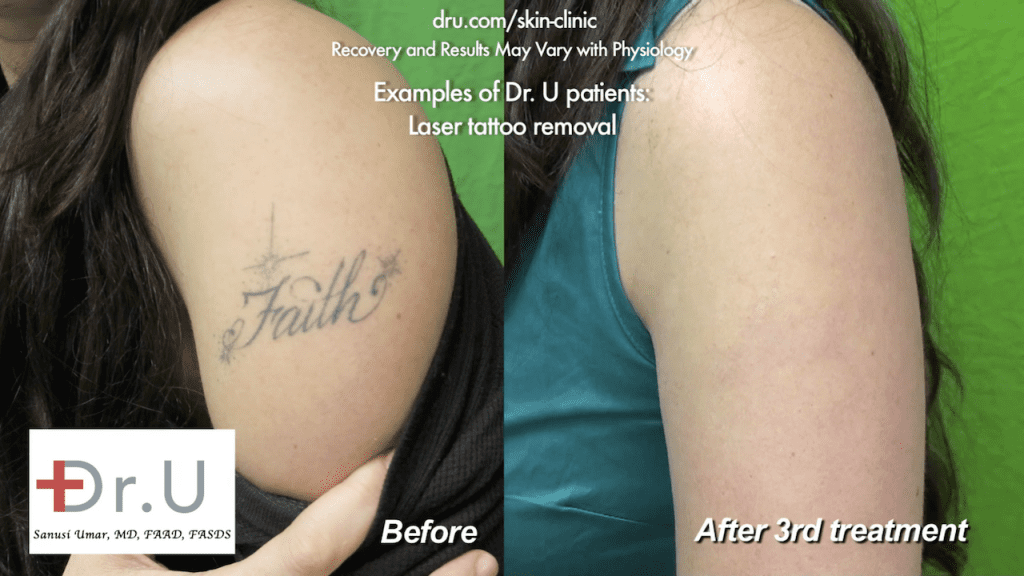 After three sessions of tattoo laser removal with Dr. Umar in Los Angeles, the patient happily shows off her ink-less arm. After three sessions of tattoo laser removal with Dr. Umar in Los Angeles, the patient happily shows off her ink-less arm.