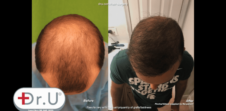 Patient is shown before his Dr.UGraft ™ hair transplant at age 23 Patient is shown before his Dr.UGraft ™ hair transplant at age 23