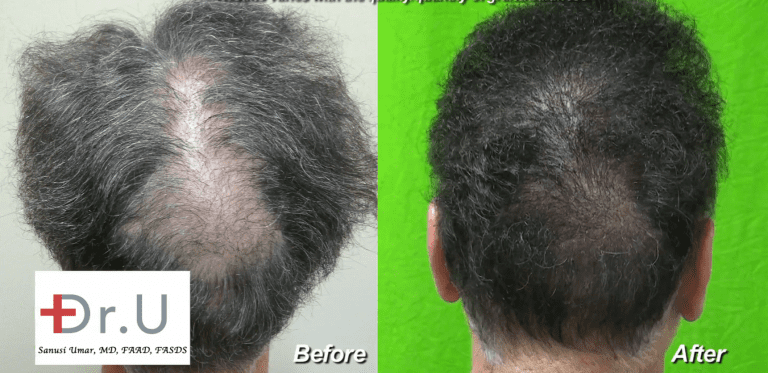 Beard hair grafts fill in crown slot from scalp reduction to produce seamless looking results