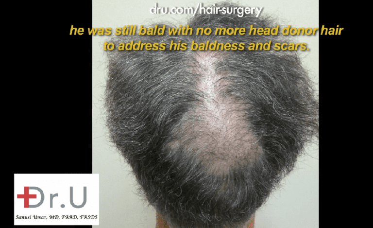 Additional donor resources are needed to fill in crown slot from scalp reduction 