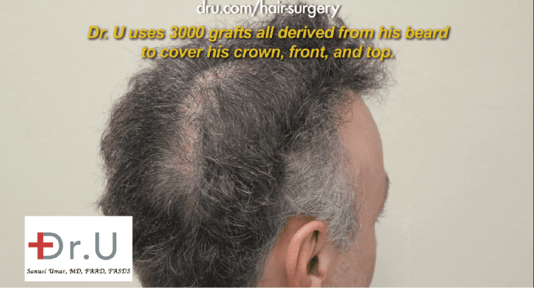 This patient required a slot deformity repair using additional donor grafts derived from non-head hair areas