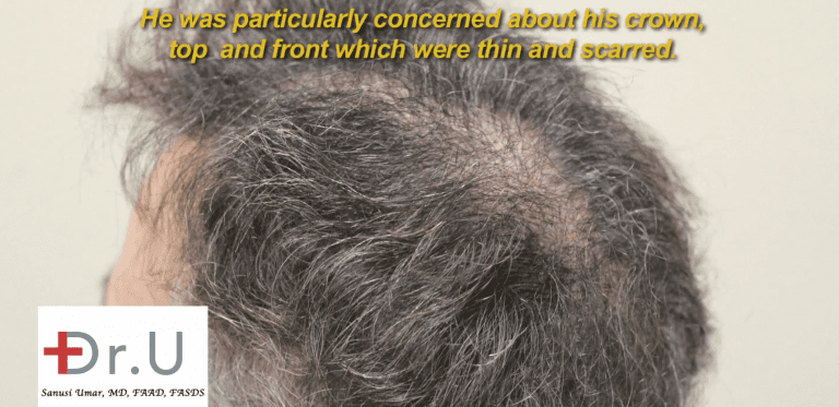 Patient no longer has enough head hair to fulfill the needs of his crown slot repair case.