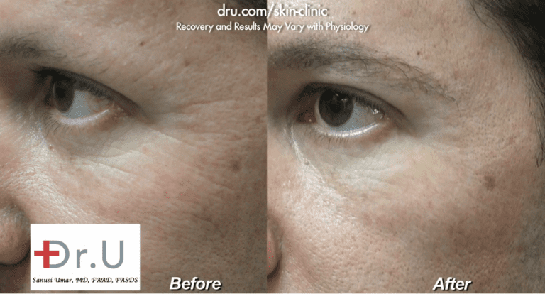 Belotero filler for crows feet produced a natural-looking reduction in the depth and number of fine lines at the corner of his eyes *