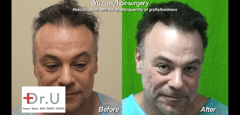 This patient finally found an ideal means to repair a crown slot from scalp reduction surgery which gave him a very natural looking outcome in the end