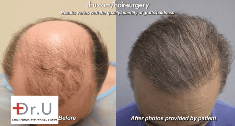 Beard hair was an effective resource to address the effect of no growth after hair transplant surgery