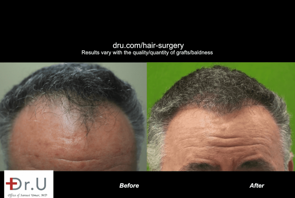 Patient is happy with his conservative hair transplant outcome which advanced his receded hairline and temples to produce a natural-looking improvement *