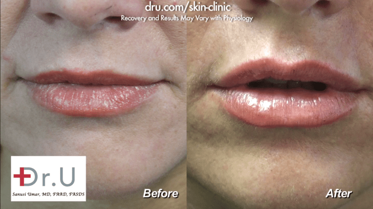 Patients often ask, how long do injectable fillers last? The answer often depends on the area that is injected and the individual's metabolism Patients often ask, how long do injectable fillers last? The answer often depends on the area that is injected and the individual's metabolism