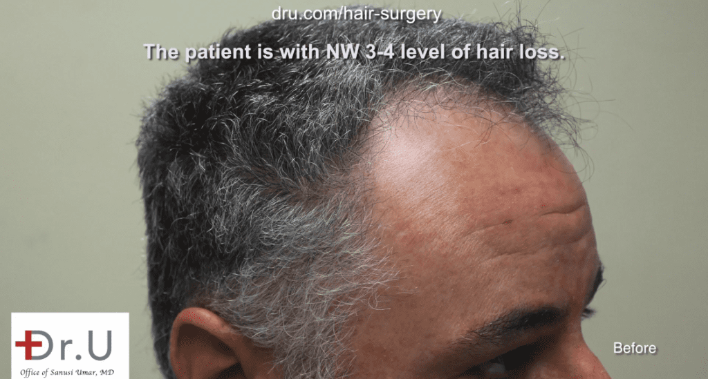 Side view of patient showing receded temples. He hopes to achieve a conservative hair transplant outcome*