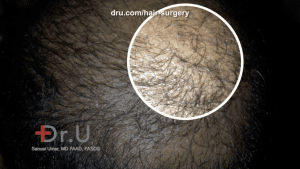 In the initial stages of hair transplant growth, around the third to fourth month, patients may start to notice pimple-like bumps, which actually is a positive sign of new growth