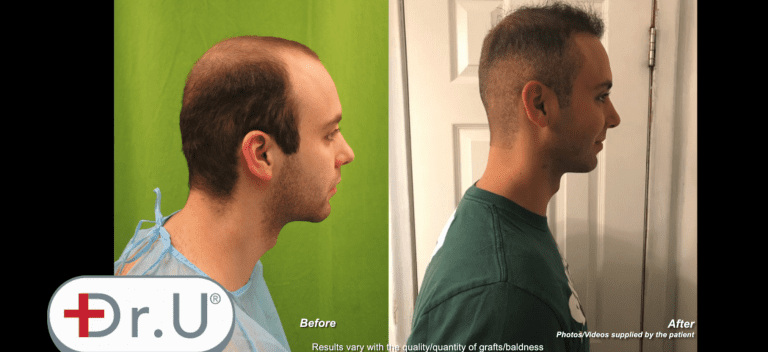 Before and after images depicting new temples, a conservative hairline and crown coverage due to the patient's Dr.UGraft™ hair transplant at age 23 Before and after images depicting new temples, a conservative hairline and crown coverage due to the patient's Dr.UGraft™ hair transplant at age 23