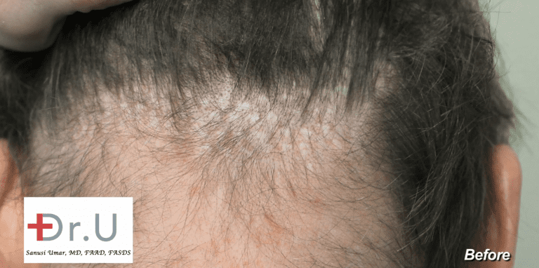 Photo of Newport Beach, Los Angeles patient showing overharvested donor area after hair transplant surgeries performed with 80's punch graft devices.