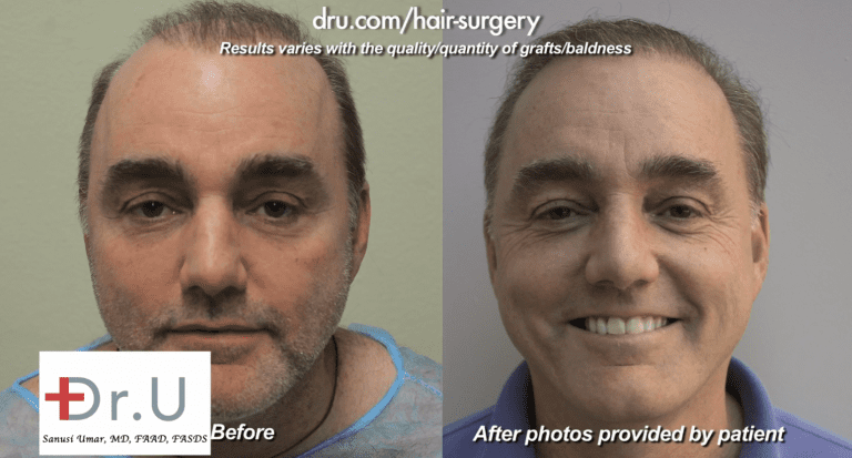 Front facial view of the patient showing the repair of pluggy doll's hair after hair transplant procedures from the 80s left patient with poor growth and cosmetic results *