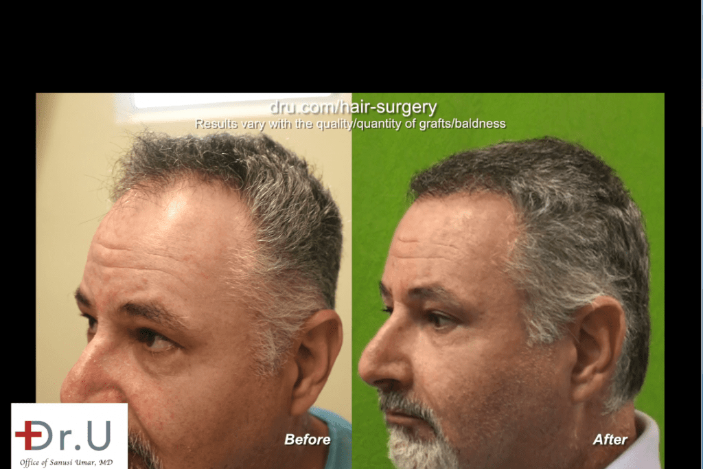 Side view of Redondo Beach patient before and after his Norwood 4 hair transplant *