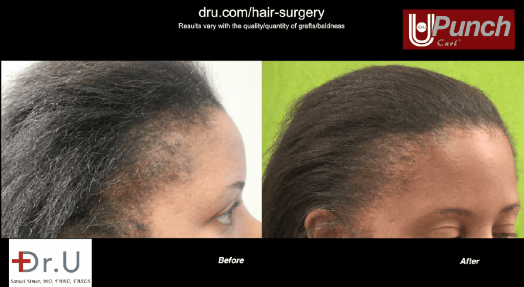 Traction alopecia prevention and treatment: This patient had abused her hair for years with braids, weaves, and tight ponytails. She later underwent the Dr.UGraft procedure to restore her hair.