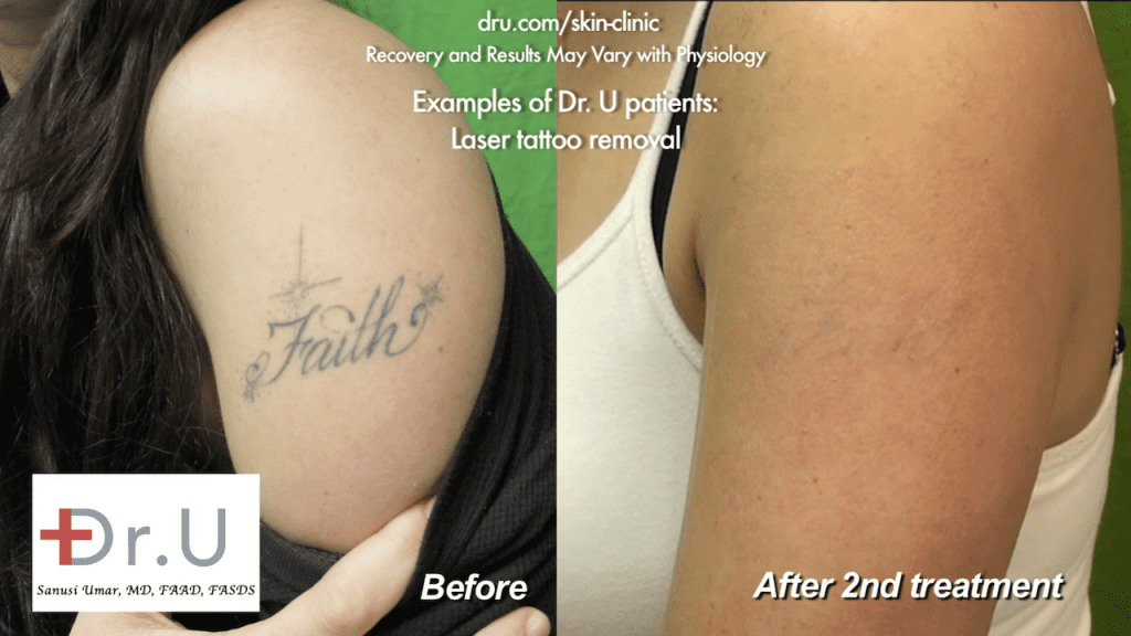 This before and after image shows the results of two sessions of tattoo removal with laser. A faint outline can still be seen, which was addressed in a follow-up session This before and after image shows the results of two sessions of tattoo removal with laser. A faint outline can still be seen, which was addressed in a follow-up session