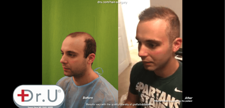 Patient defies the minimum age for a hair transplant thanks to his Dr.UGraft ™ body hair to head surgery Patient defies the minimum age for a hair transplant thanks to his Dr.UGraft ™ body hair to head surgery