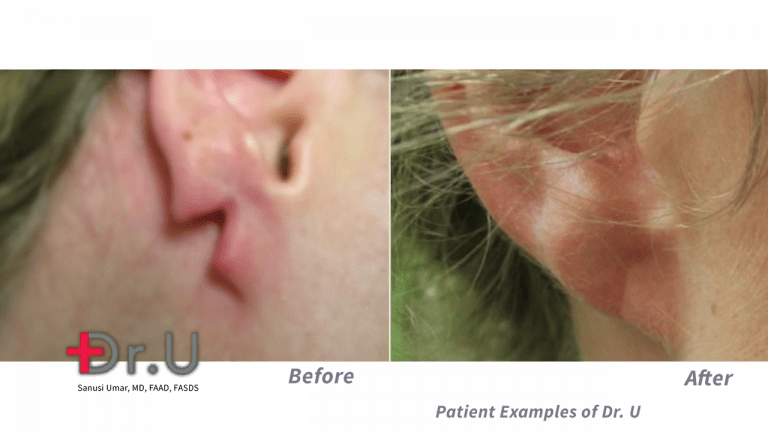 After seeing a rip or tear, many wonder "Will a split earlobe repair itself?". The answer, Dr. Umar explains, is generally "no". After seeing a rip or tear, many wonder "Will a split earlobe repair itself?". The answer, Dr. Umar explains, is generally "no".