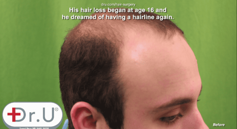 Profile view showing empty temples before his Dr.UGraft™early 20's hair transplant procedure Profile view showing empty temples before his Dr.UGraft™early 20's hair transplant procedure