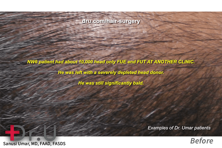 Dr. Umar’s patient was left with a very thin FUE donor area on the scalp after another clinic extracted 10,000 grafts
