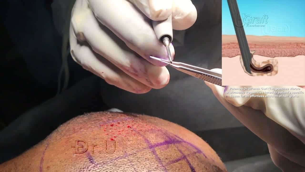 Dr. U demonstrates the ultrasonic frequency vibrating the Dr.UPunch Curl by lightly touching it to a pair of forceps. The frequency, tuned to the patient's skin characteristics, appears to minimize the issue of strong tissue attachment in afro-textured hair follicle extraction. Dr. U demonstrates the ultrasonic frequency vibrating the Dr.UPunch Curl by lightly touching it to a pair of forceps. The frequency, tuned to the patient's skin characteristics, appears to minimize the issue of strong tissue attachment in afro-textured hair follicle extraction.