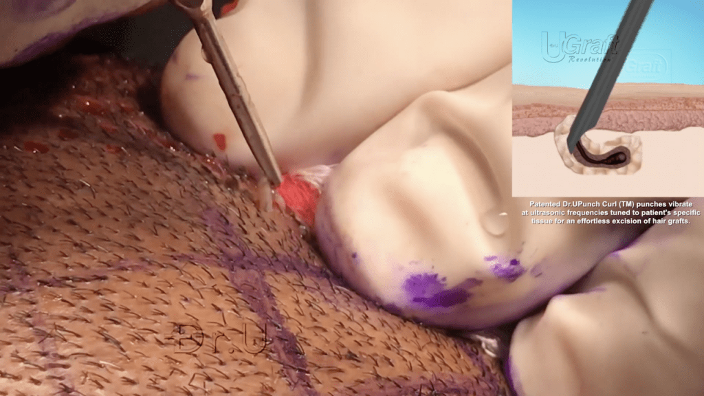 The apparent ease of extraction with Dr. UGraft™'s sonic hair transplant tools can be seen in the image above, in which a freshly scored graft is popping out of the surrounding tissue.*