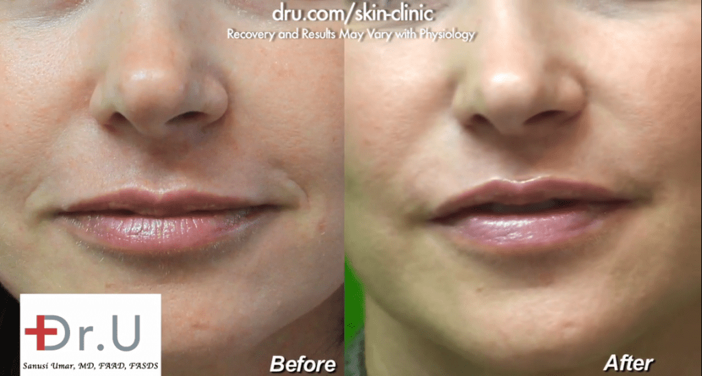 Dr. Umar used Radiesse for marionette lines that were starting to develop on this patient