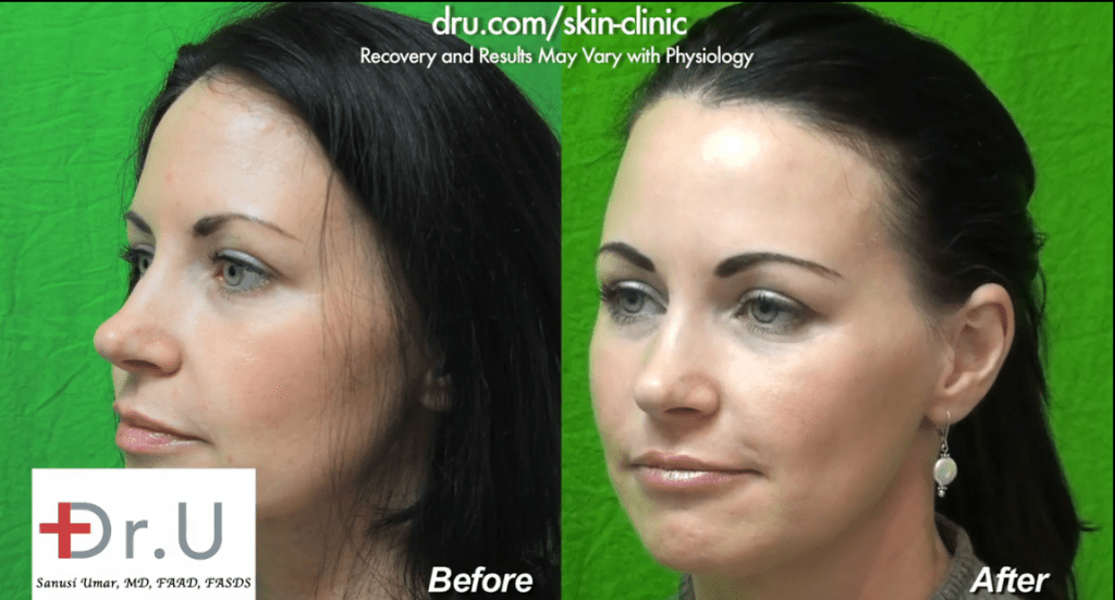 The simple use of a nasolabial fold filler can greatly improve the youthfulness of a person's face