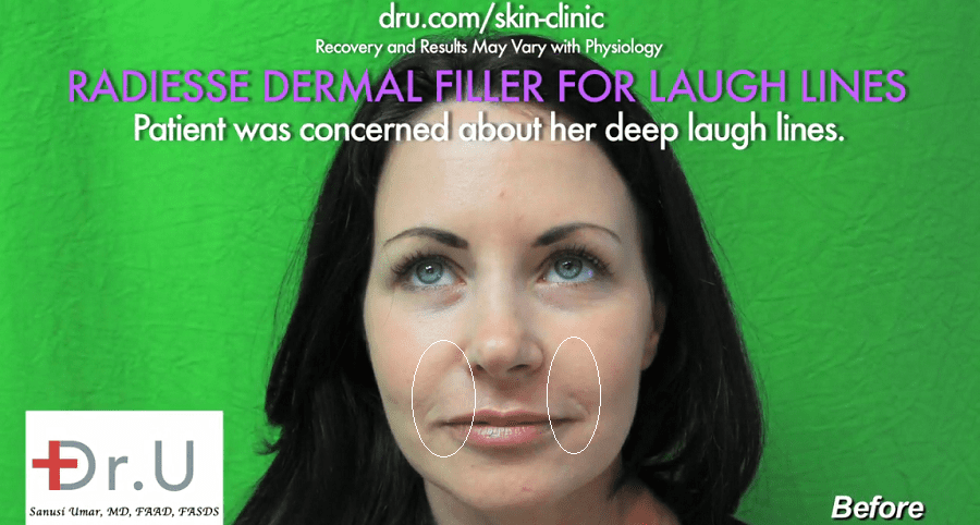 Dr. Umar (Dr.U) applied Radiesse as the best filler for nasolabial folds to meet this patient's goals 