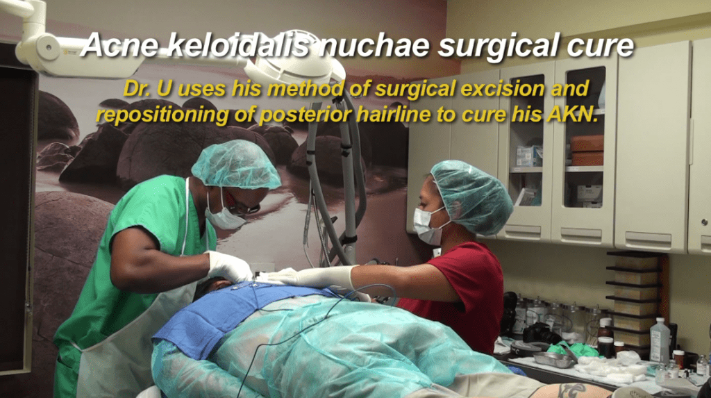 Dr. Umar performs his unique excision method to remove the pimples on back of head affected by AKN. 