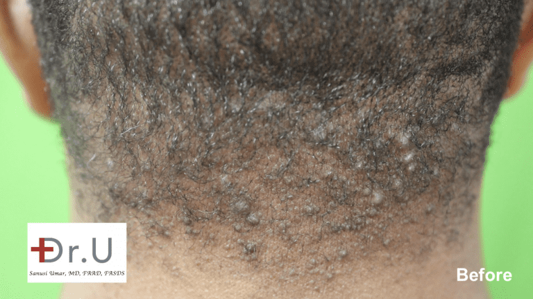 This patient came in to Dr. Umar's Los Angeles AKN Bump Clinic with hard bumps on head scalp.