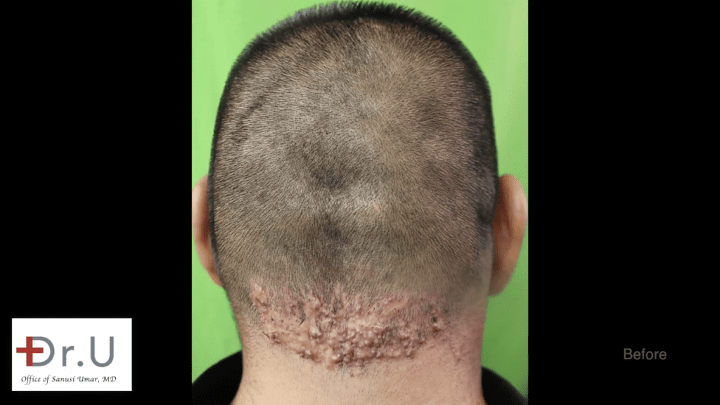 The Walnut Park patient sought a cure for chronic razor bumps behind head after previous treatments at other clinics had failed.