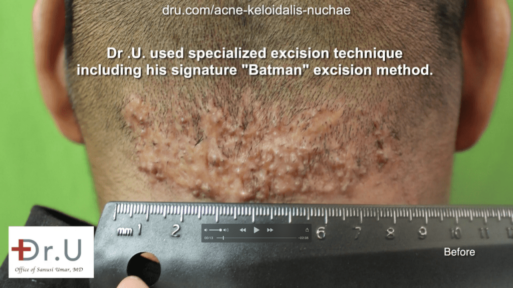 This Walnut Park patient endured symptoms of AKN like a bump on head for years before consulting at the Dr. U AKN Bump Clinic.