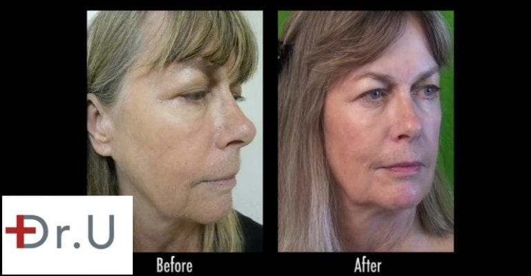 Radiesse is the best dermal filler for lifting many cases of jowls, non-surgically, as shown on this Los Angeles patient 