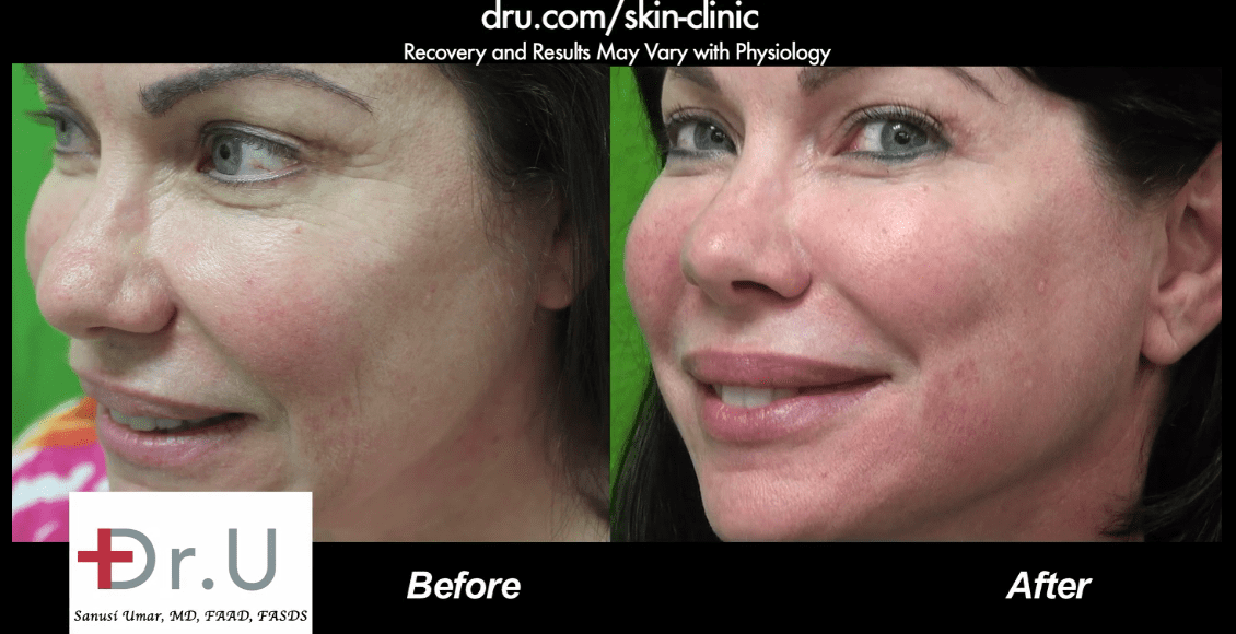 The Belotero dermal filler succeeded at eliminating the fine wrinkle shown on the side of the patient's face * The Belotero dermal filler succeeded at eliminating the fine wrinkle shown on the side of the patient's face *