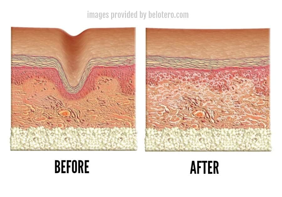 Schematic diagram showing Belotero before and after injection treatment (images provided by belotero.com) Schematic diagram showing Belotero before and after injection treatment (images provided by belotero.com)
